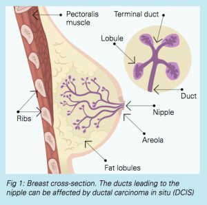 DCIS fig 1