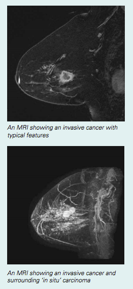 Normal breast MRI - dense breasts, Radiology Case