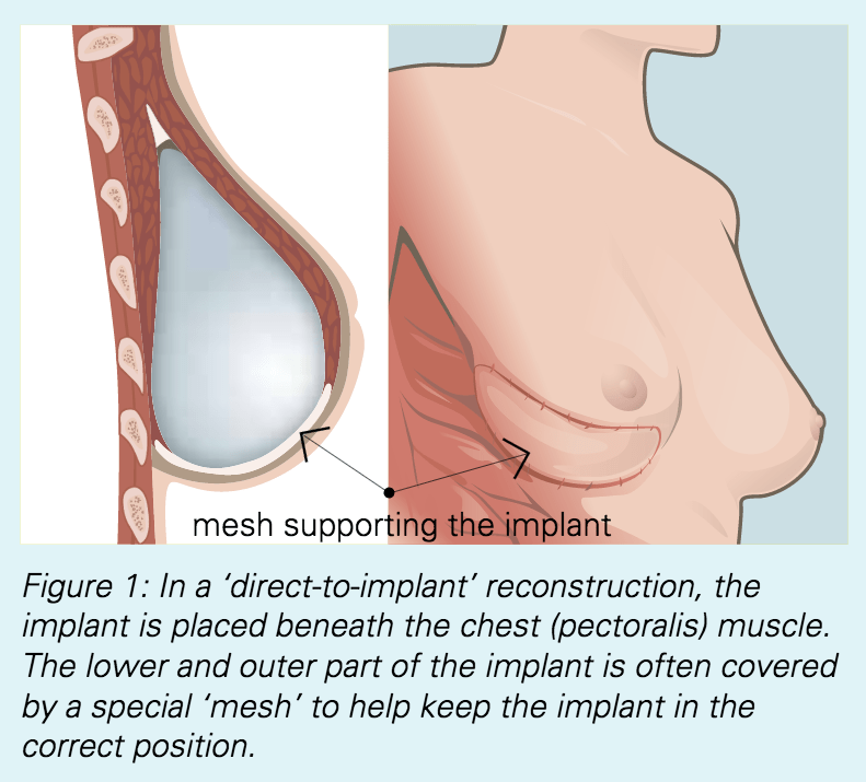 Breast Reconstruction Fact Sheet