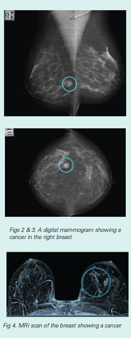 OvarianCancer_Figure2