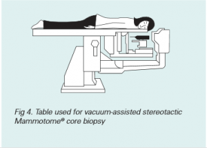 breast-biopsy_figure4