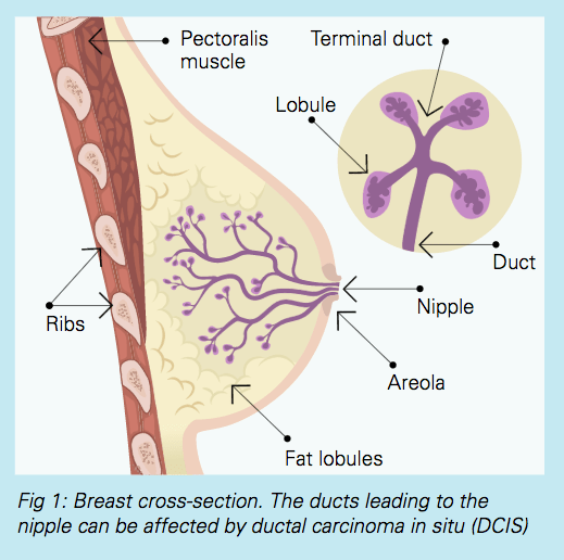 Definition of intraductal breast carcinoma - NCI Dictionary of