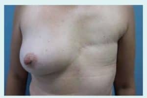 early-treatment-for-breast-cancer-figure-2