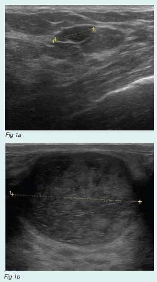Mammogram atypical mass large breasts Fibroadenoma Of The Breast Fact Sheet Westmead Bci