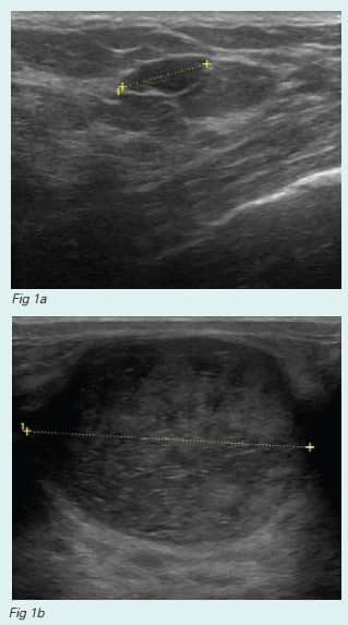 fibroadenoma-fig-1a-and-fig-1b