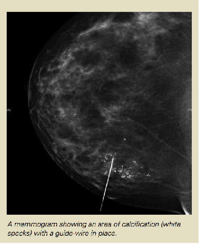 Surgical Clips in Breast-conserving Surgery: Do they Represent the Tumour  Bed Accurately?