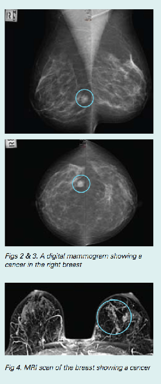 OvarianCancer_Figure2