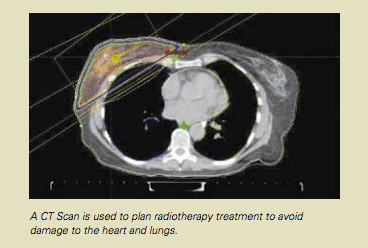 RadioTherapy-Figure2