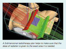 RadioTherapy-Figure3
