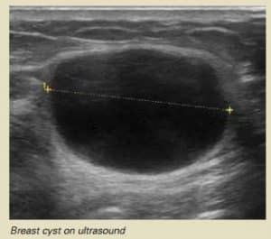 breast-cyst-on-ultrasound