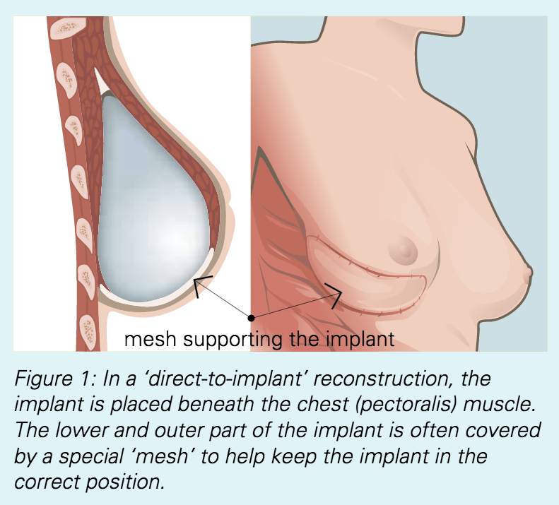 BreastReconstruct_fig1