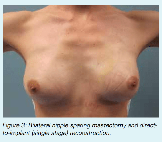 BreastReconstruct_fig3