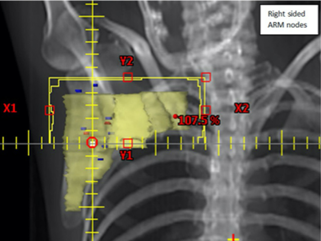 location of arm draining lymph node in relation to breast cancer radiotherapy field and target volume